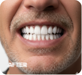 لمینت